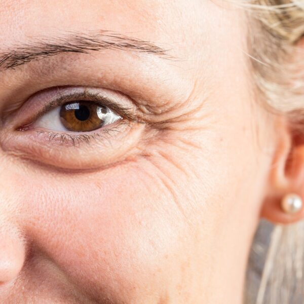 Tränensäcke behandeln: Was hilft gegen Tränensäcke, die Schwellung und wie Tränensäcke entfernen?