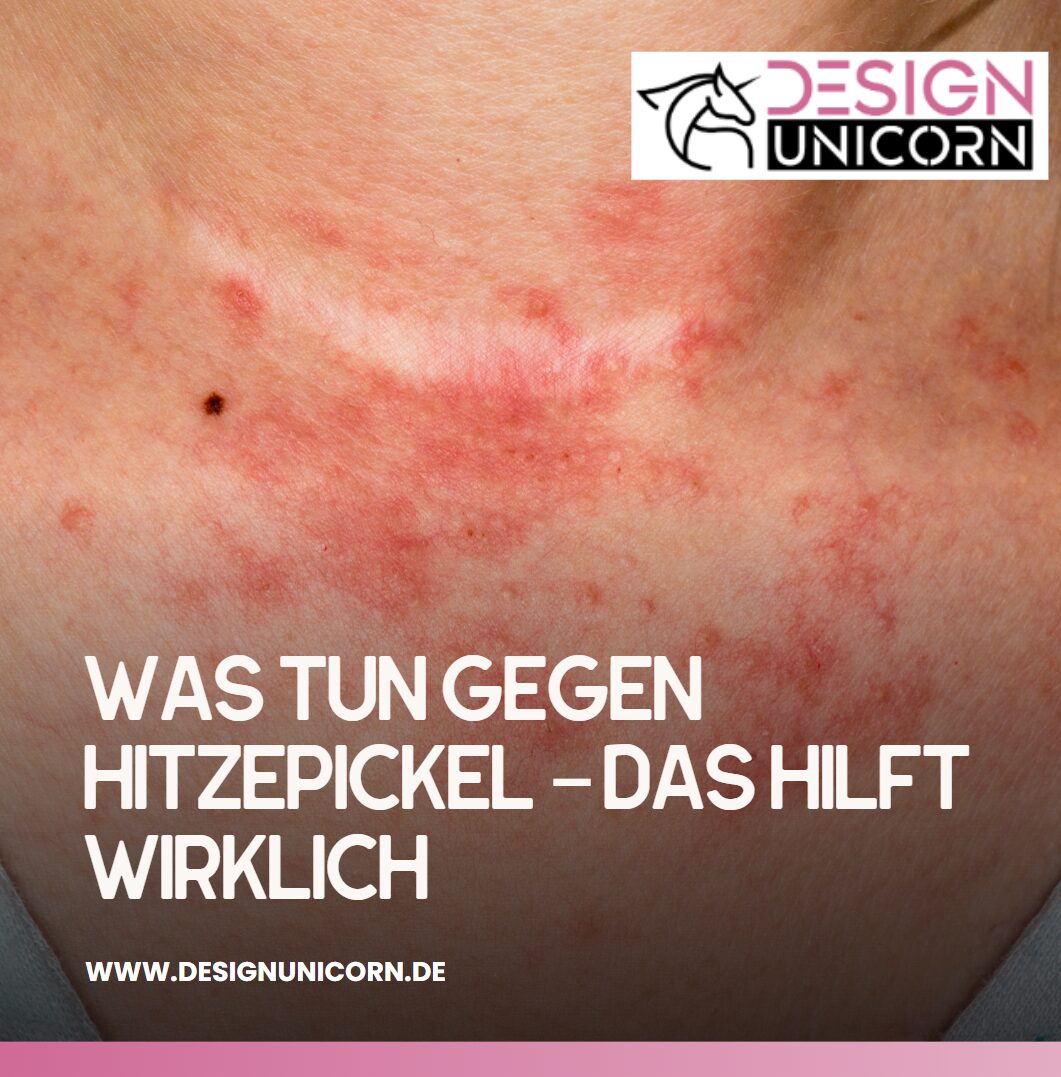 Was tun gegen Hitzepickel – das hilft wirklich