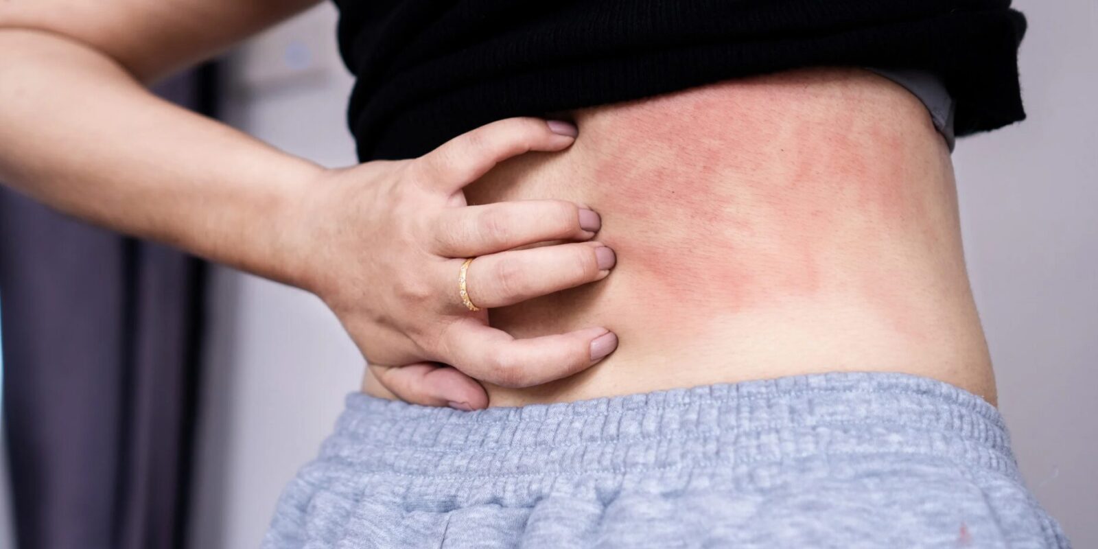 Was tun gegen Hitzepickel Der große Sommer-Guide gegen lästige Hautirritationen