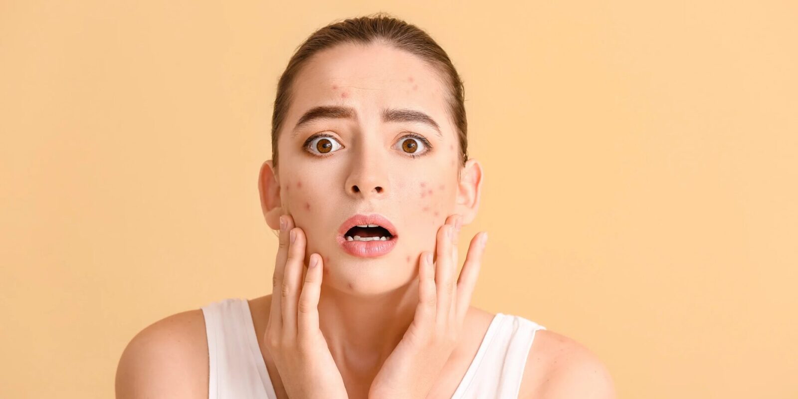 Hausmittel gegen hormonelle Akne So bekommst du unreine Haut wieder in den Griff